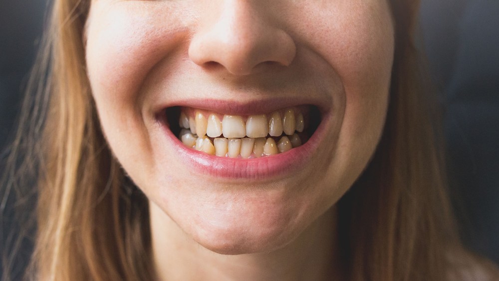 Crooked teeth in the woman's mouth. Dental decay and bad smile. Dentist treatment concept, ozempic teeth side effects